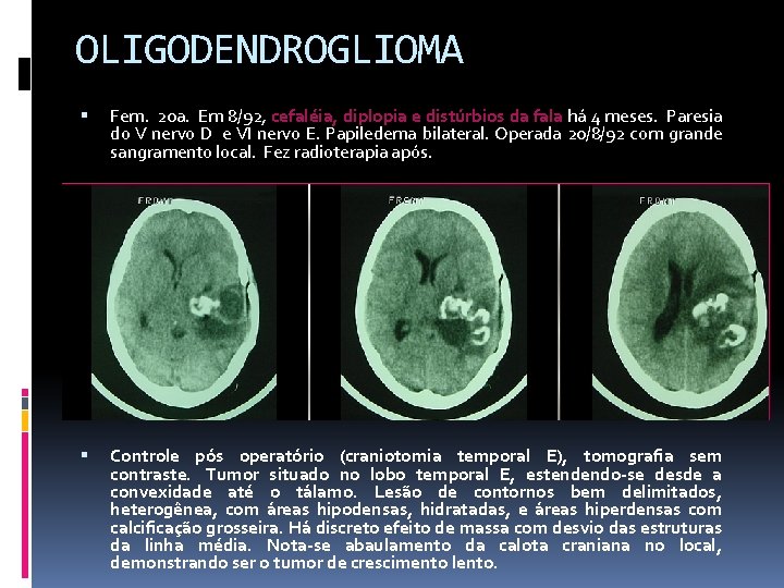 OLIGODENDROGLIOMA Fem. 20 a. Em 8/92, cefaléia, diplopia e distúrbios da fala há 4