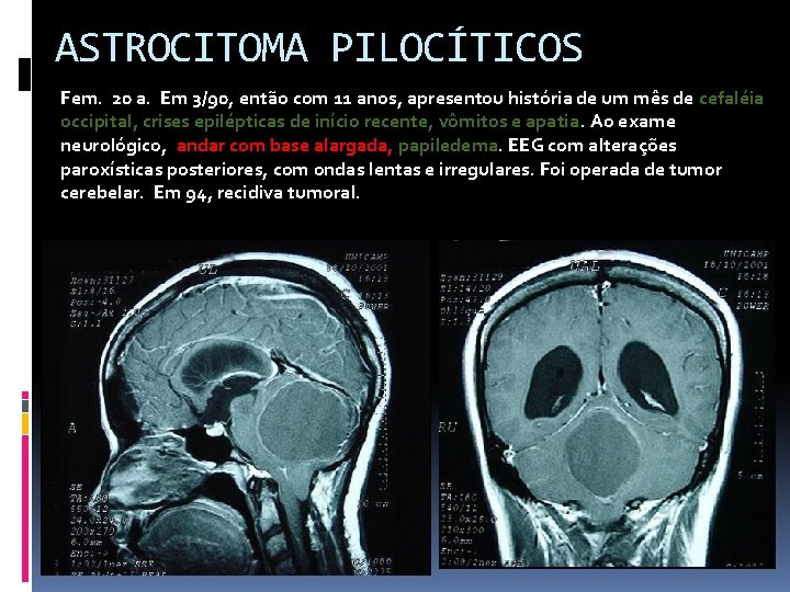 ASTROCITOMA PILOCÍTICOS Fem. 20 a. Em 3/90, então com 11 anos, apresentou história de