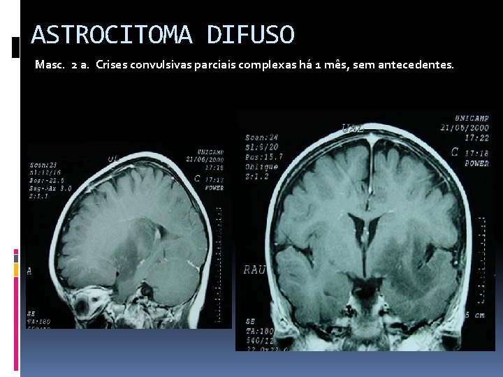 ASTROCITOMA DIFUSO Masc. 2 a. Crises convulsivas parciais complexas há 1 mês, sem antecedentes.