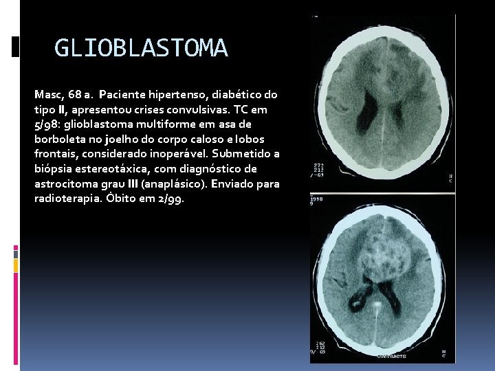 GLIOBLASTOMA Masc, 68 a. Paciente hipertenso, diabético do tipo II, apresentou crises convulsivas. TC