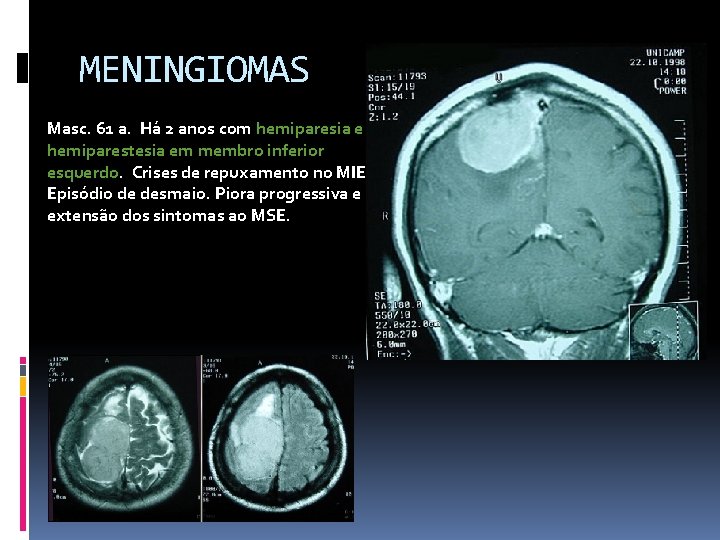 MENINGIOMAS Masc. 61 a. Há 2 anos com hemiparesia e hemiparestesia em membro inferior