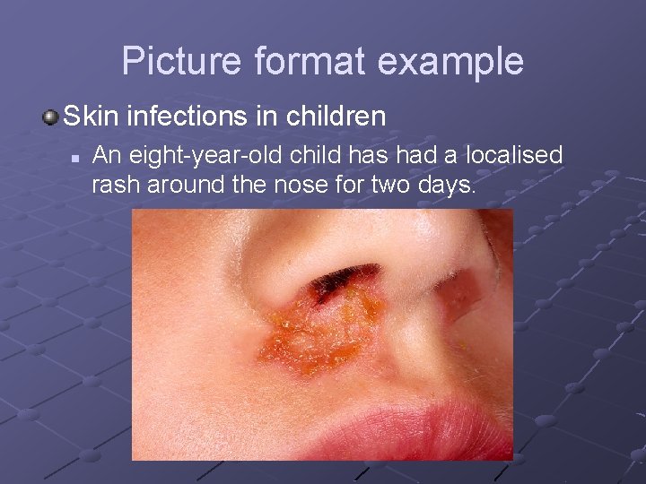 Picture format example Skin infections in children n An eight-year-old child has had a