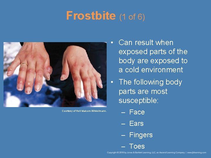 Frostbite (1 of 6) • Can result when exposed parts of the body are