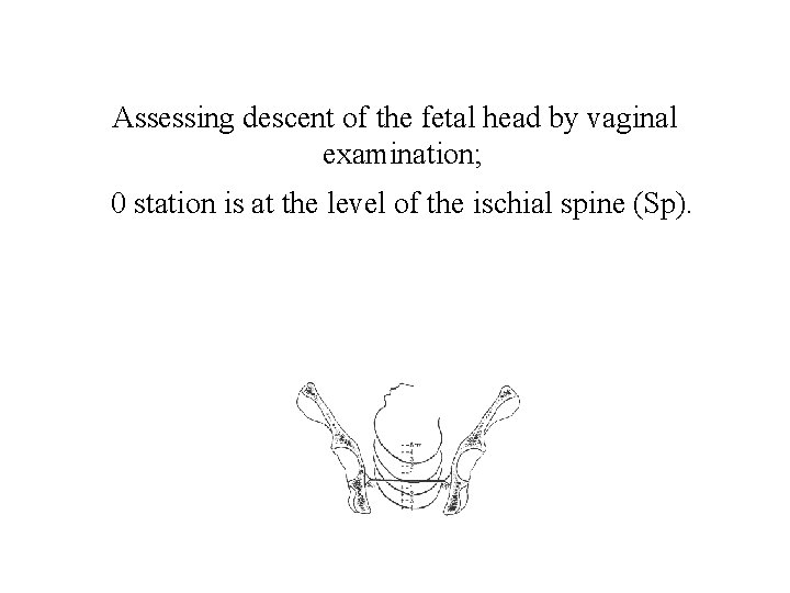 Assessing descent of the fetal head by vaginal examination; 0 station is at the