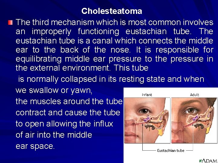Cholesteatoma The third mechanism which is most common involves an improperly functioning eustachian tube.