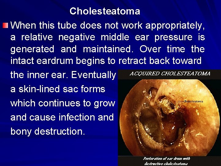 Cholesteatoma When this tube does not work appropriately, a relative negative middle ear pressure