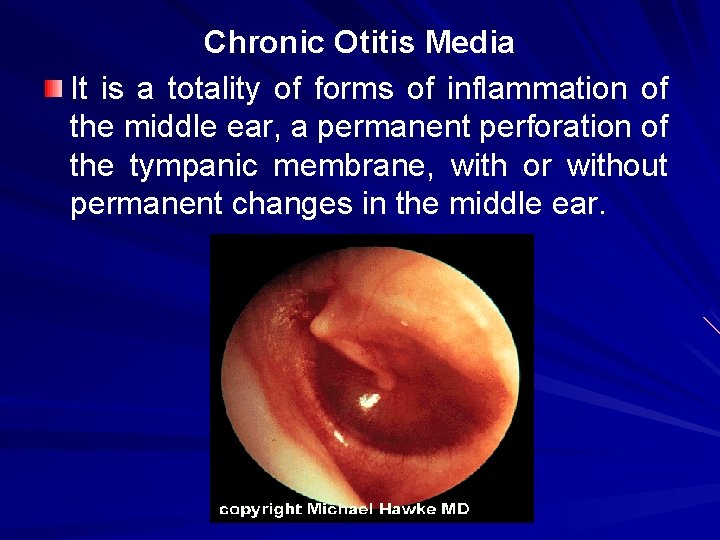 Chronic Otitis Media It is a totality of forms of inflammation of the middle