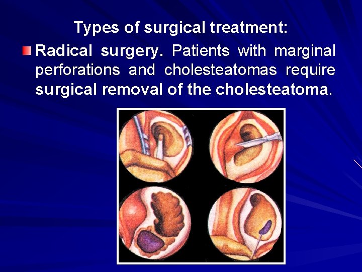 Types of surgical treatment: Radical surgery. Patients with marginal perforations and cholesteatomas require surgical