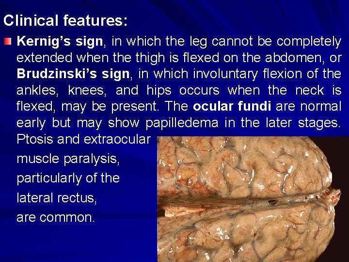 Clinical features: Kernig’s sign, in which the leg cannot be completely extended when the