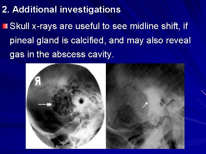 2. Additional investigations Skull x-rays are useful to see midline shift, if pineal gland