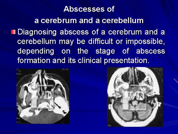 Abscesses of a cerebrum and a cerebellum Diagnosing abscess of a cerebrum and a