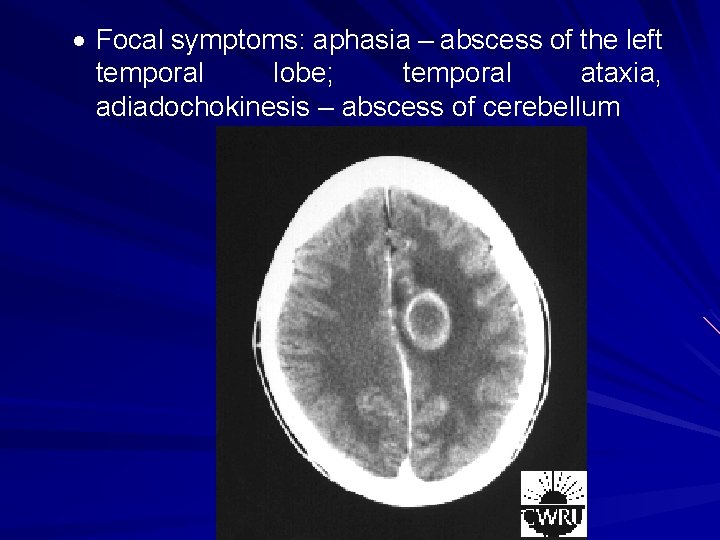  Focal symptoms: aphasia – abscess of the left temporal lobe; temporal ataxia, adiadochokinesis