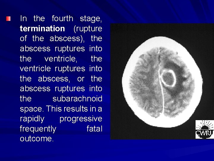In the fourth stage, termination (rupture of the abscess), the abscess ruptures into the