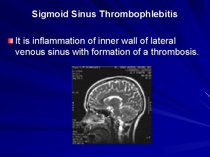 Sigmoid Sinus Thrombophlebitis It is inflammation of inner wall of lateral venous sinus with