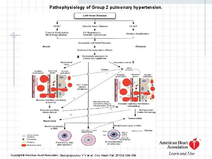 Pathophysiology of Group 2 pulmonary hypertension. Copyright © American Heart Association Georgiopoulou V V