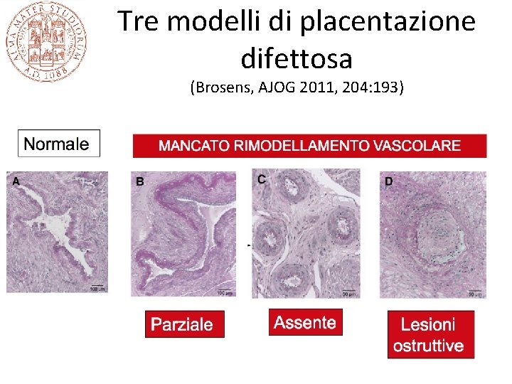 Tre modelli di placentazione difettosa (Brosens, AJOG 2011, 204: 193) 