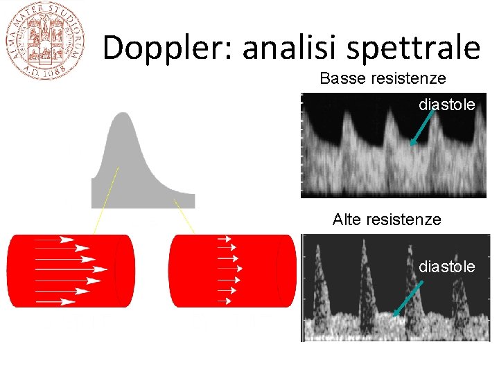 Doppler: analisi spettrale Basse resistenze diastole Alte resistenze diastole 