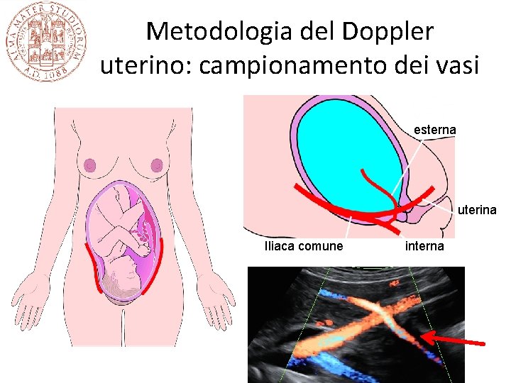 Metodologia del Doppler uterino: campionamento dei vasi esterna uterina Iliaca comune interna 