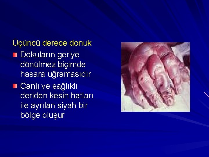 Üçüncü derece donuk Dokuların geriye dönülmez biçimde hasara uğramasıdır Canlı ve sağlıklı deriden kesin