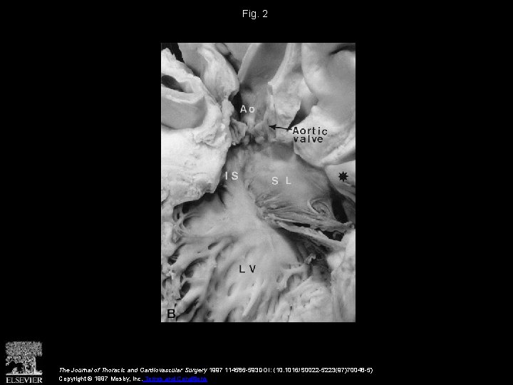 Fig. 2 The Journal of Thoracic and Cardiovascular Surgery 1997 114586 -593 DOI: (10.