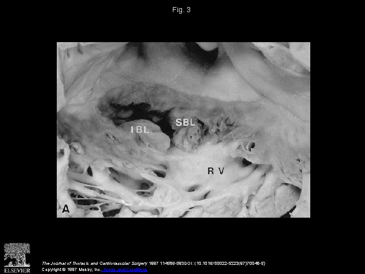 Fig. 3 The Journal of Thoracic and Cardiovascular Surgery 1997 114586 -593 DOI: (10.