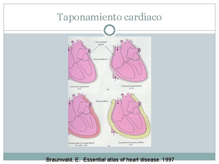 Taponamiento cardiaco Braunwald, E. Essential atlas of heart disease. 1997 