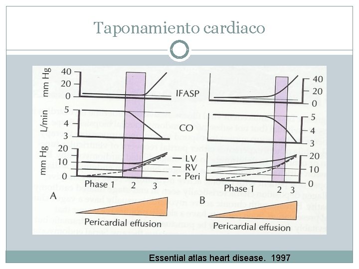 Taponamiento cardiaco Essential atlas heart disease. 1997 