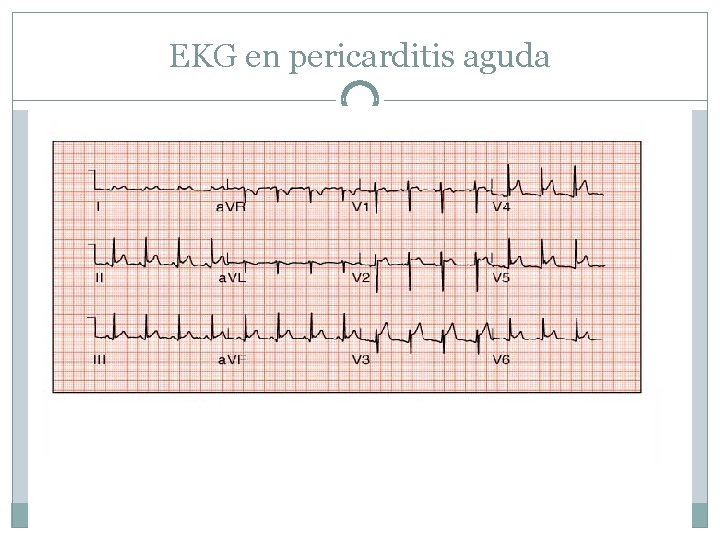 EKG en pericarditis aguda 