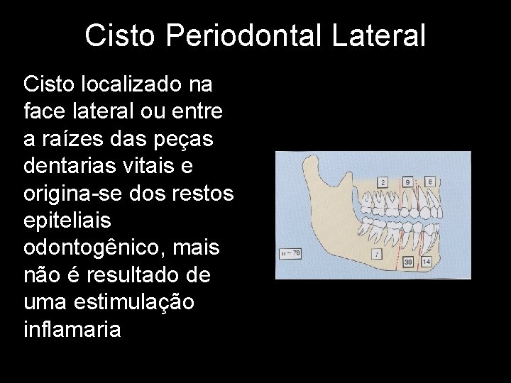 Cisto Periodontal Lateral Cisto localizado na face lateral ou entre a raízes das peças