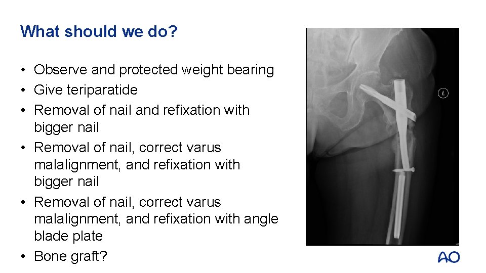 What should we do? • Observe and protected weight bearing • Give teriparatide • What should we do? • Observe and protected weight bearing • Give teriparatide •