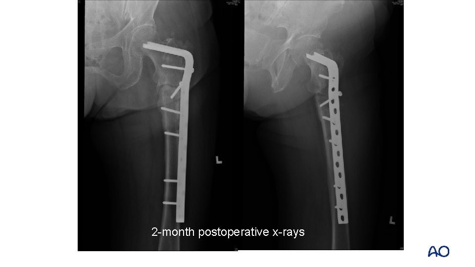 2 -month postoperative x-rays 2 -month postoperative x-rays