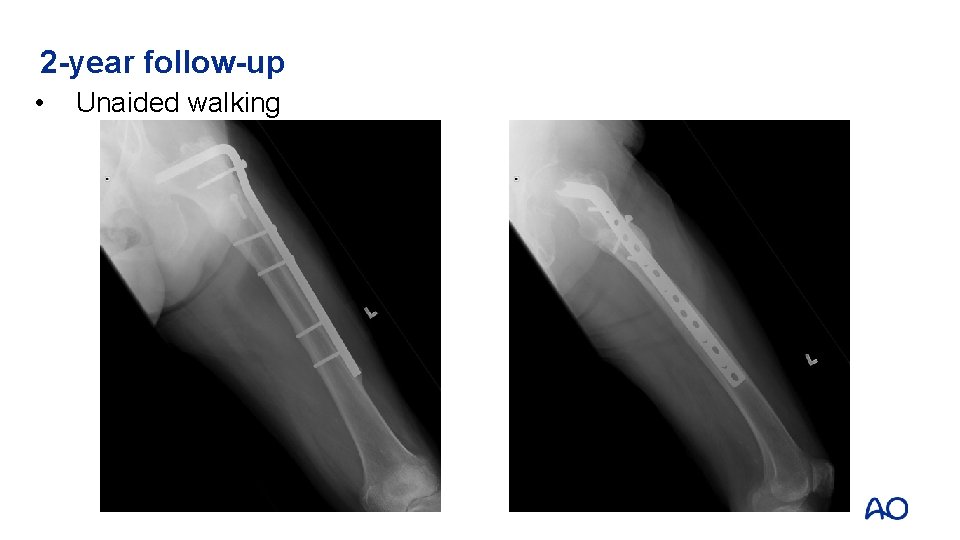 2 -year follow-up • Unaided walking 2 -year follow-up • Unaided walking