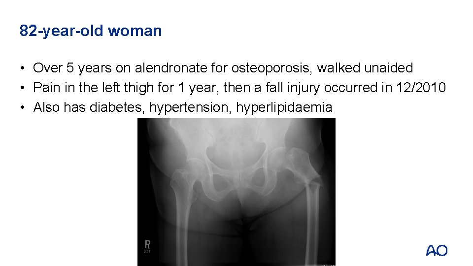 82 -year-old woman • Over 5 years on alendronate for osteoporosis, walked unaided • 82 -year-old woman • Over 5 years on alendronate for osteoporosis, walked unaided •