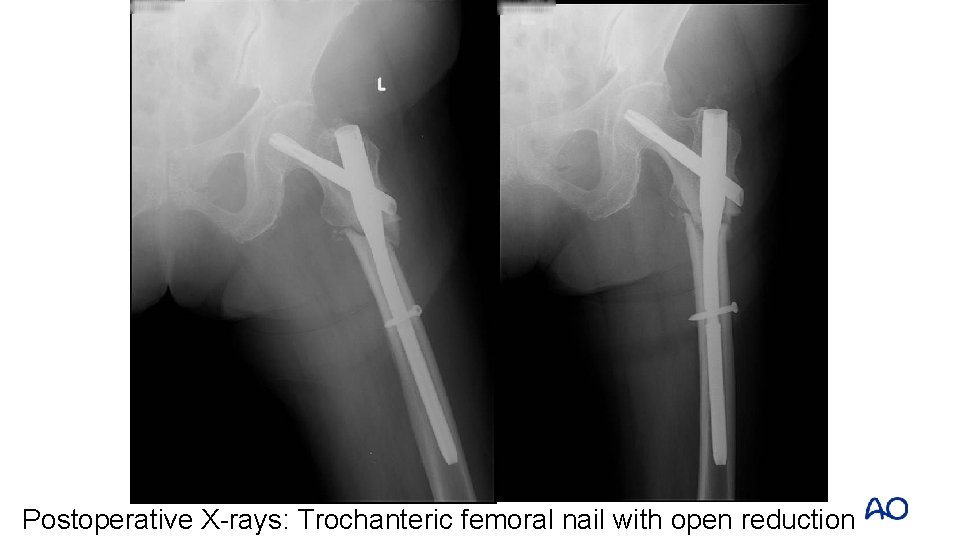Postoperative X-rays: Trochanteric femoral nail with open reduction Postoperative X-rays: Trochanteric femoral nail with open reduction