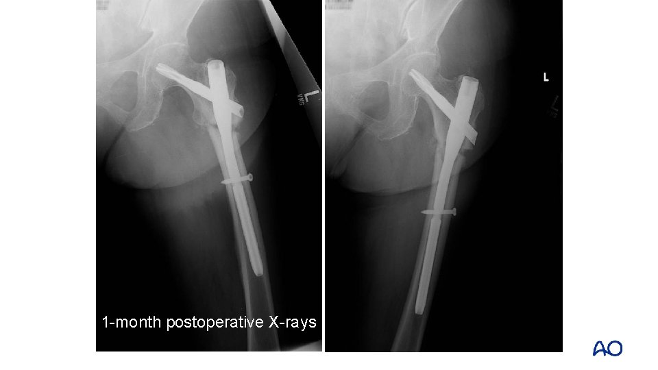 1 -month postoperative X-rays 1 -month postoperative X-rays