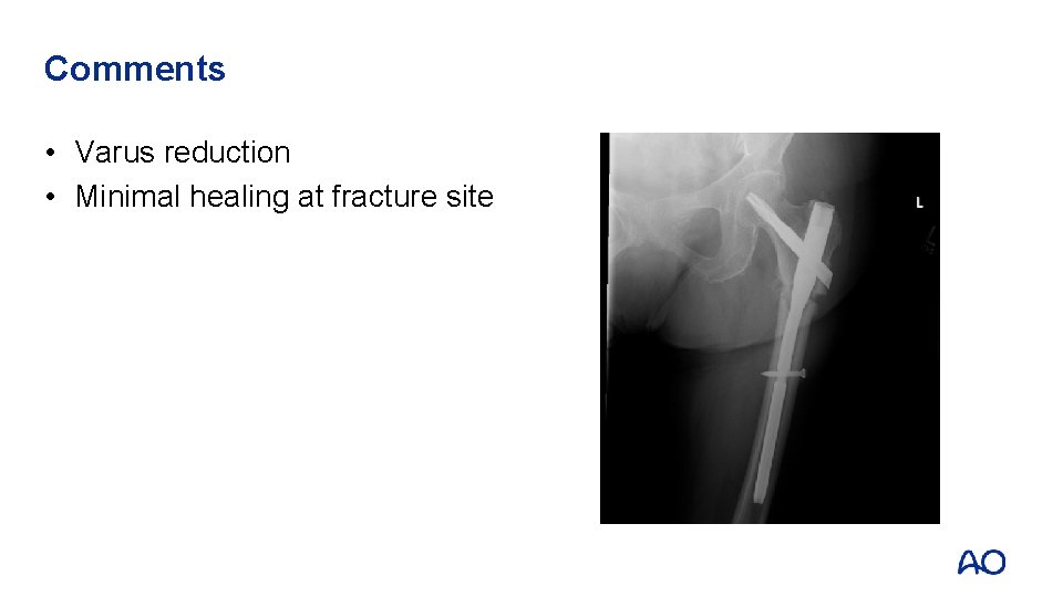 Comments • Varus reduction • Minimal healing at fracture site Comments • Varus reduction • Minimal healing at fracture site