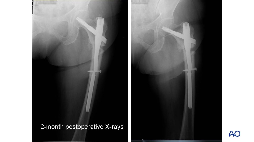 2 -month postoperative X-rays 2 -month postoperative X-rays