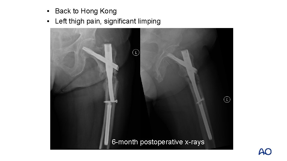 • Back to Hong Kong • Left thigh pain, significant limping 6 -month • Back to Hong Kong • Left thigh pain, significant limping 6 -month