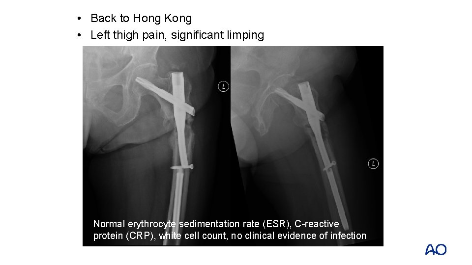 • Back to Hong Kong • Left thigh pain, significant limping Normal erythrocyte • Back to Hong Kong • Left thigh pain, significant limping Normal erythrocyte