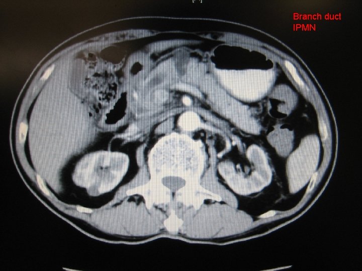 CT Branch duct IPMN 