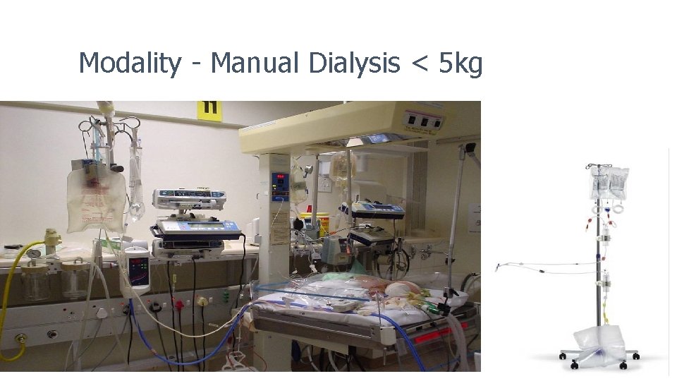 Modality - Manual Dialysis < 5 kg 