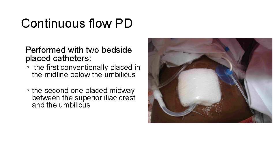 Continuous flow PD • Performed with two bedside placed catheters: ▫ the first conventionally