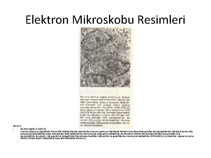 Elektron Mikroskobu Resimleri Resim. 6. Normal Vagina. (X. 6210+4). Stratum Spinosum Süperficiale (Precornifie Tabaka)