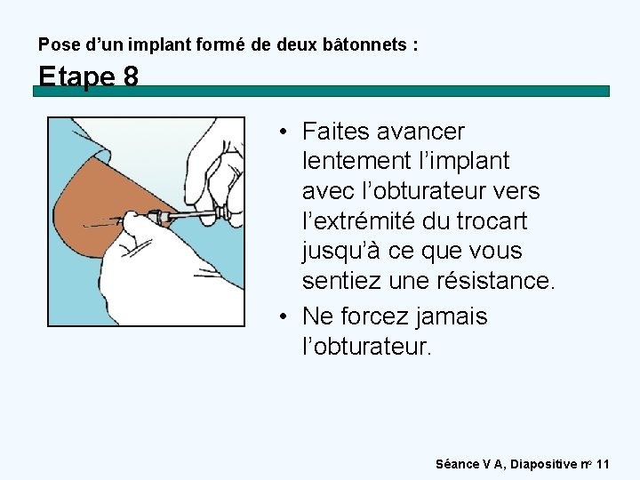 Pose d’un implant formé de deux bâtonnets : Etape 8 • Faites avancer lentement