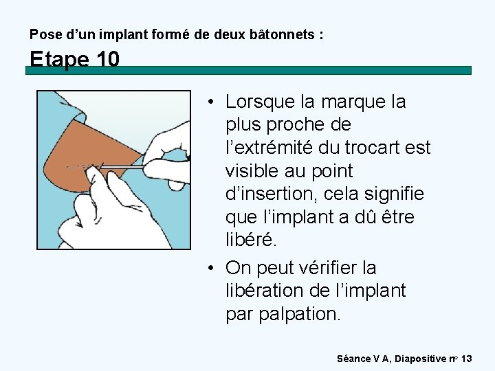 Pose d’un implant formé de deux bâtonnets : Etape 10 • Lorsque la marque