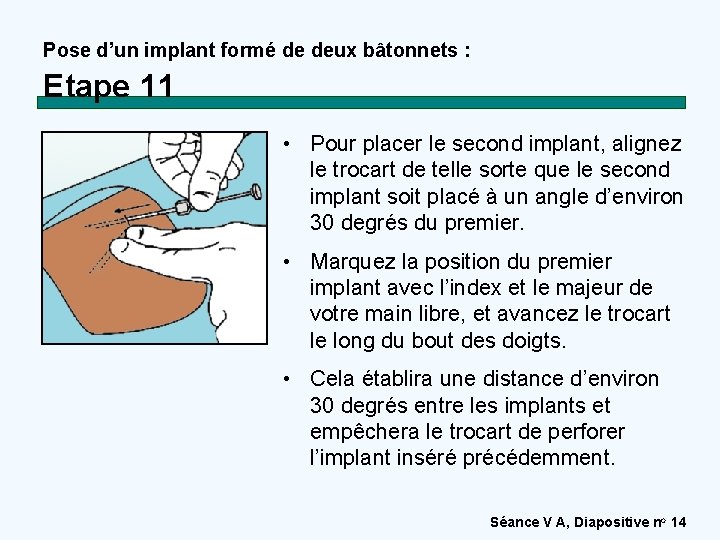 Pose d’un implant formé de deux bâtonnets : Etape 11 • Pour placer le