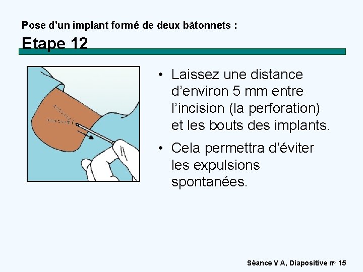 Pose d’un implant formé de deux bâtonnets : Etape 12 • Laissez une distance