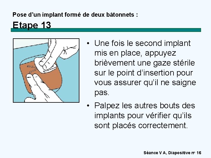 Pose d’un implant formé de deux bâtonnets : Etape 13 • Une fois le