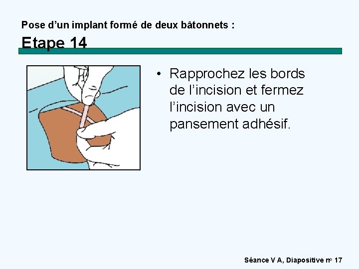 Pose d’un implant formé de deux bâtonnets : Etape 14 • Rapprochez les bords