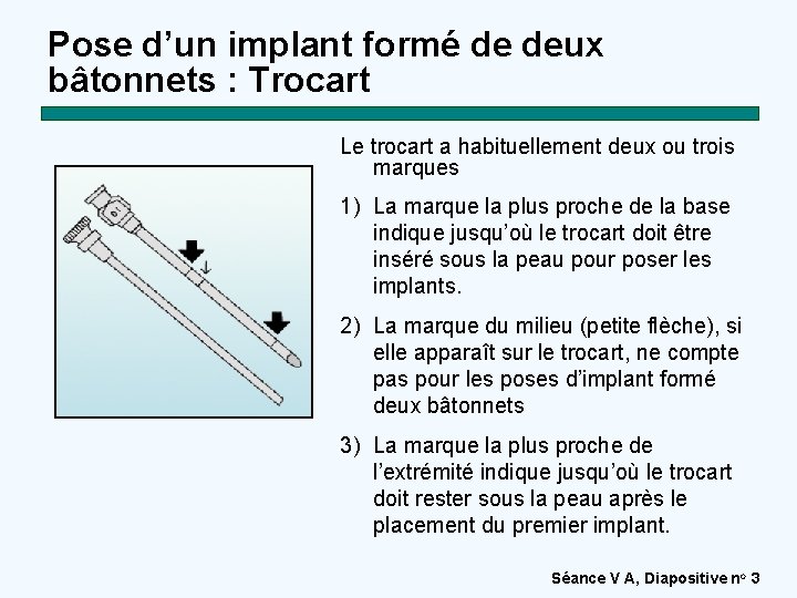 Pose d’un implant formé de deux bâtonnets : Trocart Le trocart a habituellement deux